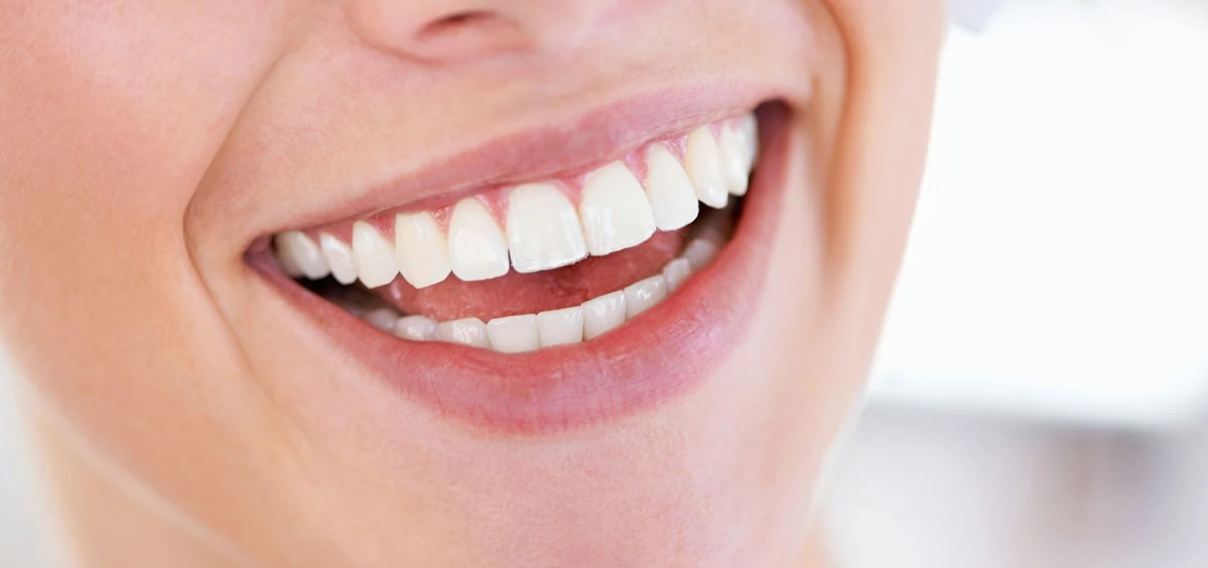 Sourire aligné grâce aux aligneurs transparents