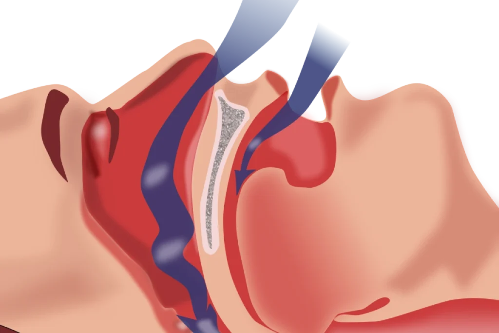 Apnée du sommeil - Dentiste Alfortville 94140, près de Paris