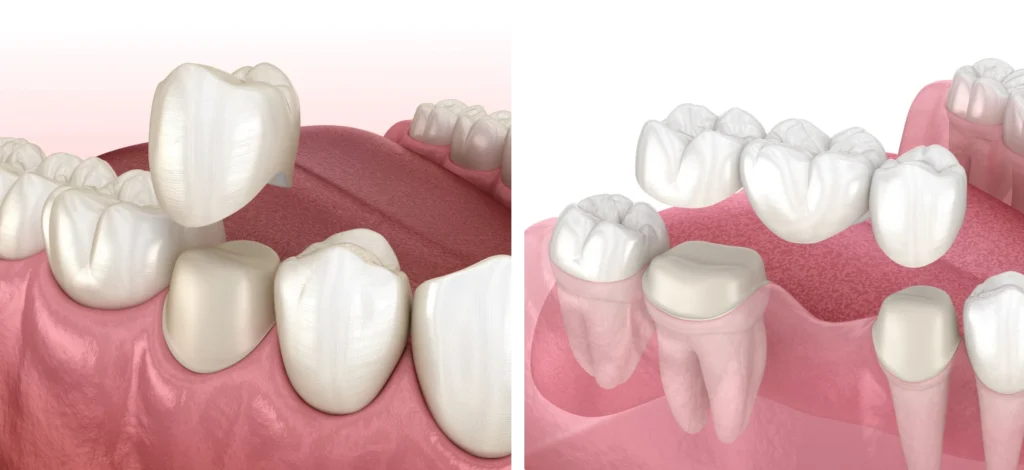 Couronnes, Dentiste Alfortville 94140, près de Paris
