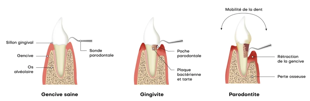 Parodontie médicale Dentiste Alfortville